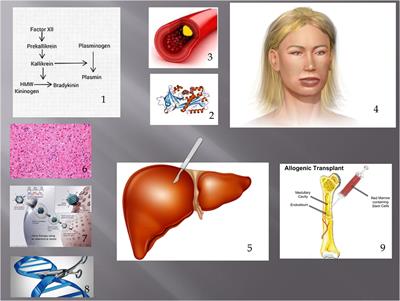 Hereditary Angioedema as a Metabolic Liver Disorder: Novel Therapeutic Options and Prospects for Cure